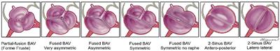 Bicuspid Aortic Valve Stenosis: From Pathophysiological Mechanism, Imaging Diagnosis, to Clinical Treatment Methods